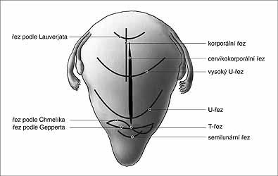 3.3.3 Chirurgické techniky VOLBA LAPAROTOMIE 1.nejčastější přístupovou cestou k dolnímu segmentu je laparotomie podle Pfannenstiela suprapubický řez ( Herman Johannsen Pfannenstiel ) 2.