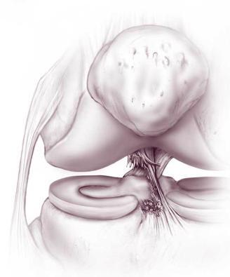 Obrázek 6 Poranění LCA (zdroj: http://healthpages.org/wpcontent/uploads/2010/06/reconstru cted-acl.jpg) Obrázek 8 Štěp z lig. patellae (zdroj: http://healthpages.