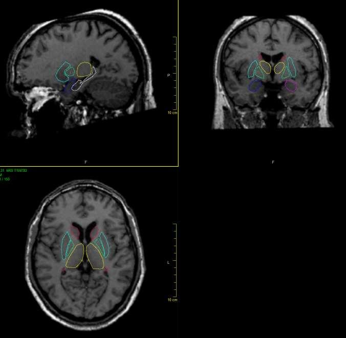 BG na MR Ncl caudatus Putamen Globus pallidus