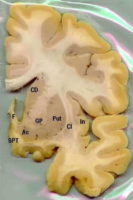 Frontální řezy telencephalem v rostro-caudálním pořadí 2 2 1 1 1 - capsula interna 2 - corpus callosum Ac ncl.