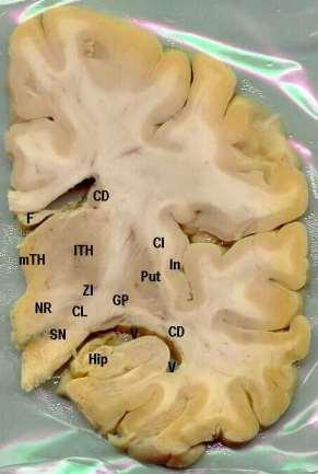 Frontální řezy telencephalem 2 1 2 1 1 - capsula interna 2 - corpus callosum Am amygdala ATH přední jádra thalamu CD-ncl caudatus Cl claustrum CL- ńcl.