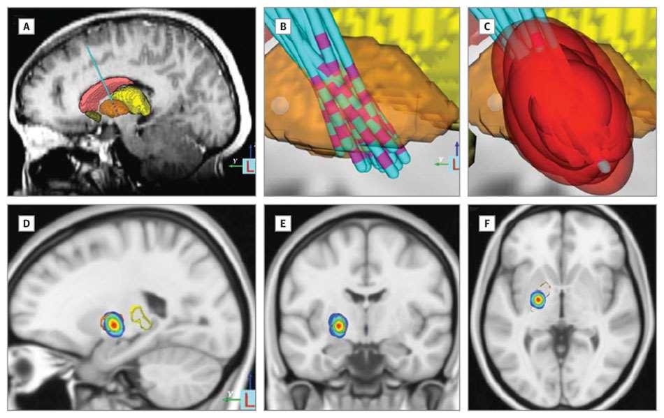 Deep Brain Stimulation Target in the Globus Pallidus Based on Retrospective Analysis of the Site of Effective Electrode Contacts and Modeling of Stimulation Fields Magnetic resonance imaging was used