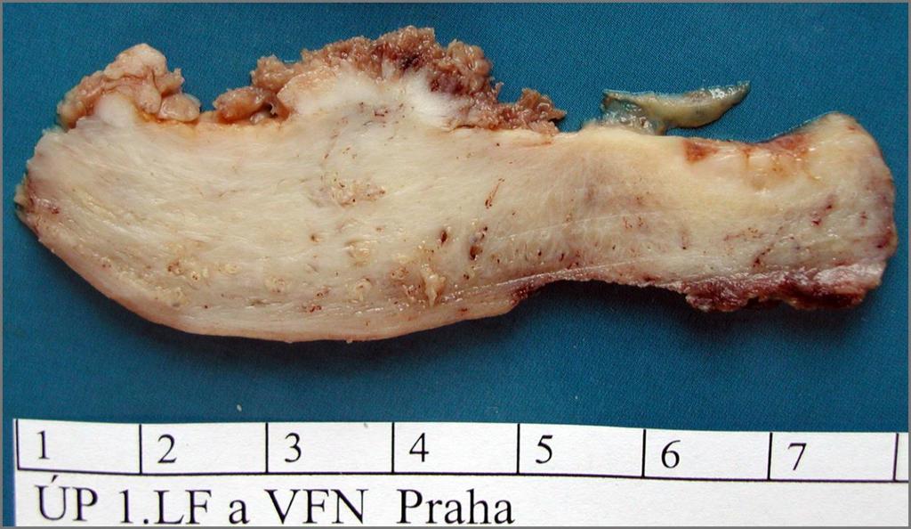 Maligní nádor variabilně diferencovaný cytologie: - mohou být jaderné anaplazie - mohou být