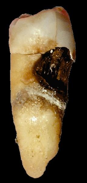 Zubní kaz Obrázek z Wikimedia commons