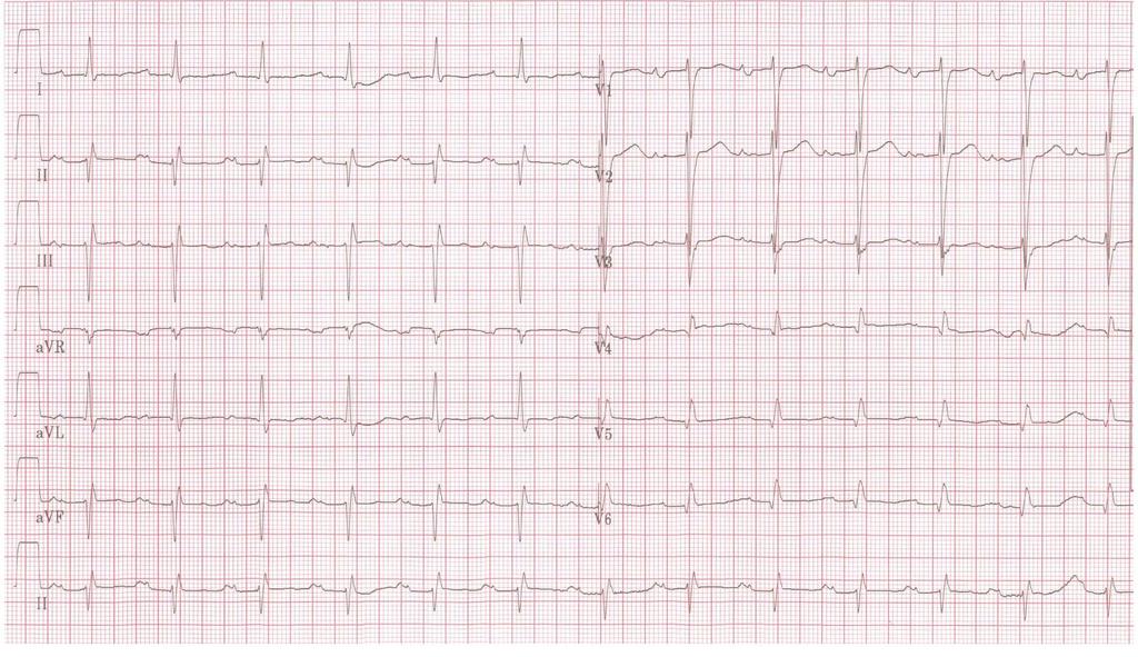 sinusový rytmus 74/min, PQ 0,24, QRS 0,10,