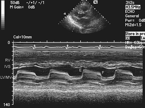 Mitrální stenóza 2D, M-mode