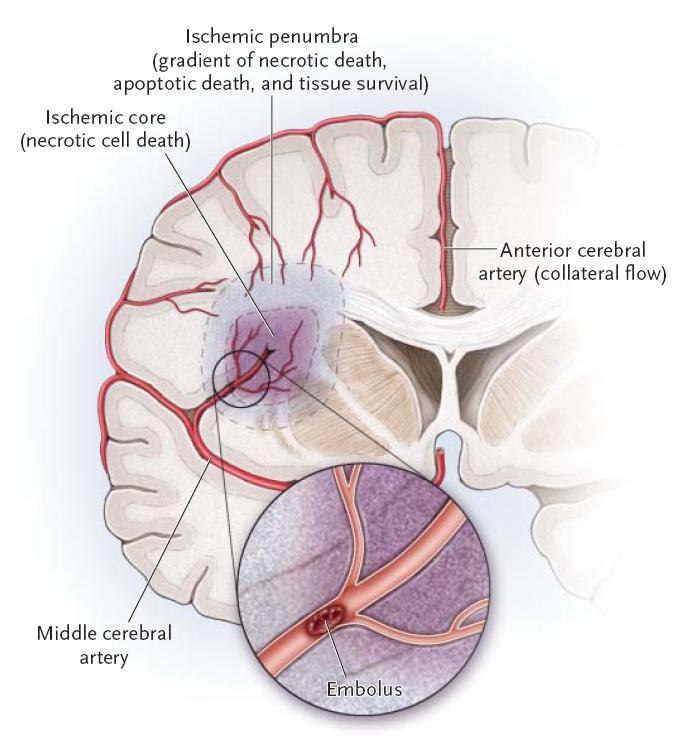 Apoptóza a nekróza při nemoci Ischemická penumbra (gradient nekrózy, apoptózy a přežití