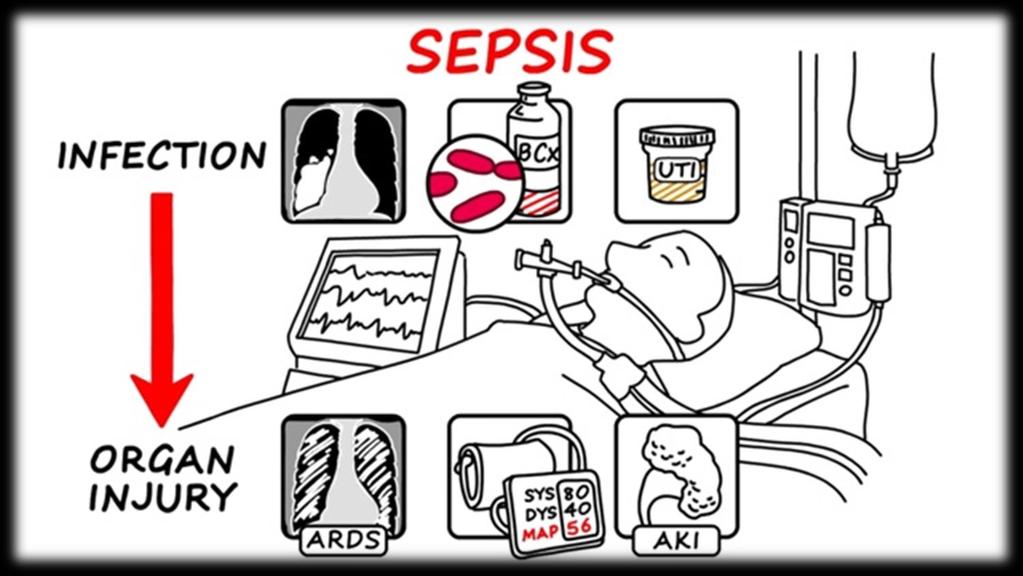 SEPSIS III klinická kritéria Infekce Orgánová dysfunkce Orgánová dysfunkce akutní změna v hodnotě SOFA skóre 2