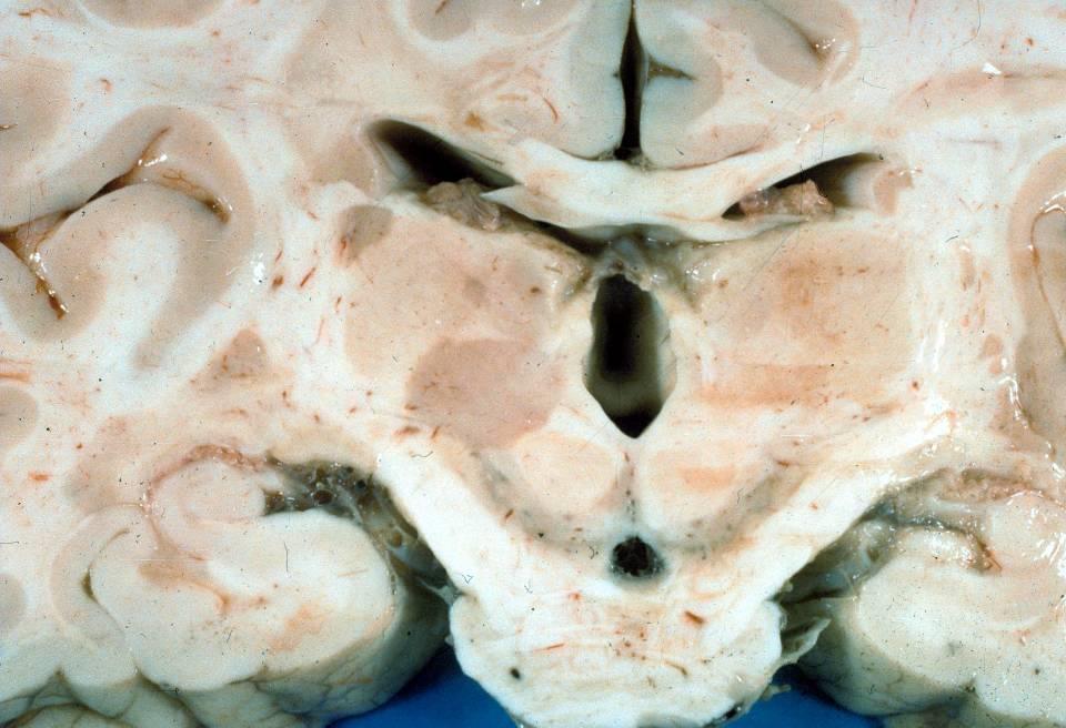 Sclerosis cerebrospinalis