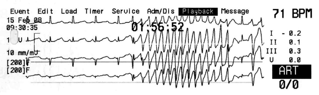 E KG p r o p r a x i Stanovení a význam QT intervalu MUDr. Václav Durdil k eliminaci vlivu srdeční frekvence se QT interval koriguje na tzv.
