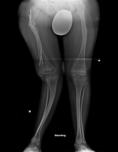 Obrázek 21: Pravá strana kostí nohy postižena osteomalacii (Internet 20). Mezi nejčastější patologii patří osteoartróza. Výskyt osteoartrózy stoupá s věkem.