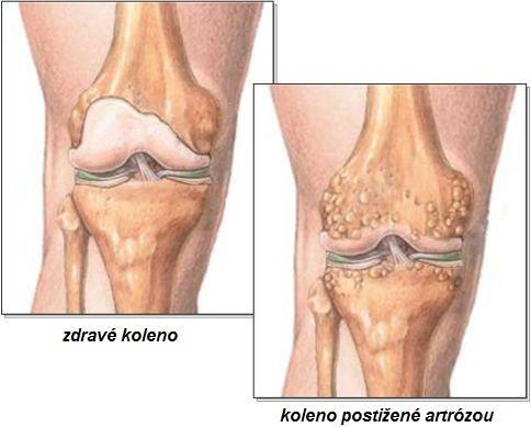 Obrázek 22: Kolenní kloub postižený osteoartrózou a patrnými osteofyty (Internet 21). 12.4.