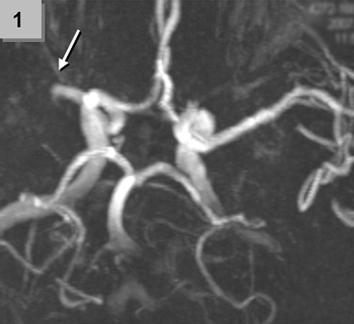 Studie IST-3 (Third International Stroke Trial) byla zahájena v roce 2000, podávána je t-pa v klasickém dávkování, a to do 6 hodin od vzniku iktu.