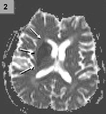 DWI, PWI). DWI sekvence (difuzně vážené snímky) zobrazují poruchu transportu molekul vody (resp. protonů), ke kterému při mozkové ischémii dochází.