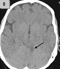 Na angiolince potvrzen přetrvávající uzávěr (1) a poté lokálně aplikováno celkem 9 mg t-pa s následnou kompletní rekanalizací tepny (2) a regresí, neurologického deficitu.