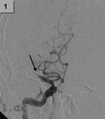 Guidelines for the early management of adults with ischemic stroke: a guideline from the American Heart Association/American Stroke Association Stroke Council, Clinical Cardiology Council,