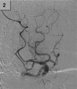 of Neurology affirms the value of this guideline as an educational tool for neurologists. Stroke, 2007. 38(5): p. 1655 1711. 2. Albers GW et al.