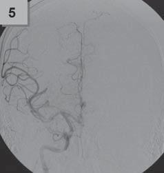 carotis interna vpravo, způsobené tandemovou lézí uzávěrem M1 se subtotální stenózou ACI vpravo, NIHSS 17. Intravenózní trombolýza bez efektu.