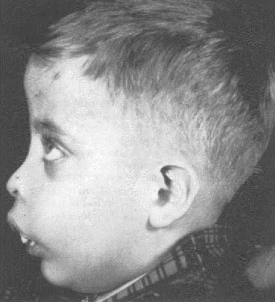 BETA THALASÉMIE (2) β+ THALASEMIE: částečně zachována tvorba řetězce lehčí průběh βº THALASEMIE: zcela chybí řetězec těžší průběh široká škála klinických projevů podle stupně postižení syntézy B