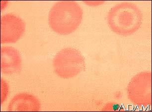 ALFA TALASÉMIE (3) Diagnostika: - KO : hypochromní mikrocytární anémie není anizocytóza ale: hemolýza = přímý i nepřímý bili, Fe feritin - drepanocyty,