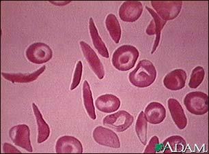 SRPKOVITÁ ANÉMIE /2 Klinický nález: hemolýza - anémie (hemol. ev aplastické krize) splenomegalie.