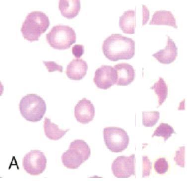 MIKROANGIOPATICKÉ HEMOLYTICKÉ ANÉMIE /3 Mechanismus: poškození endotelu cévní stěny - uvolnění multimerů vw f.