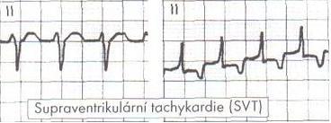 (tř. Ic) a digoxin v případě selhání levé komory srdeční. Adenosin vyvoláním úplné AV-blokády může být účinný u AV uzlové reentry tachykardie.