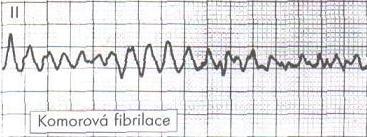 pohybuje v rozpětí 140-220/min, QRS komplex je vždy aberantní. P vlny mohou být skryty v QRS komplexexh. V rozpacích o povaze tachykardie je účelné považovat tachykardii za komorovou a takto ji léčit.