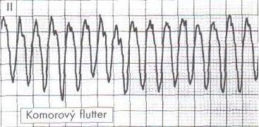 s odstupem opakovat), součástí léčby je i vysazení léčiv prodlužujících QT interval (chinidin, amiodaron, tricyklická antidepresiva, prokinetika cisaprid aj.). Arytmie vyvolané předávkováním kardioglykosidy (digitalis): KES a KT - trimekain, betablokátory (pozor na AV-blokádu!