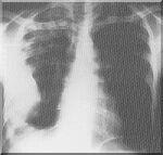 Mycobacterium tuberculosis PATOGENITA: Tuberkulóza: Vdechnutí do plic Primární komplex (zánětliv