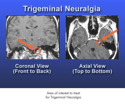 Neuralgia trigeminalis (Tic