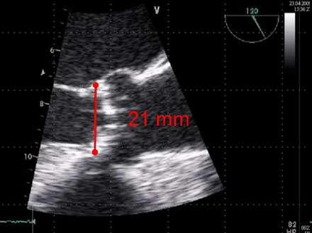 Transkatétrové náhrady aortálnej chlopne