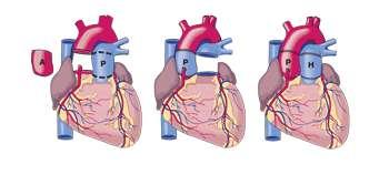 Možnosti náhrady aortálnej chlopne. Autograft Ross 1967 Implantácia pulmonálnej chlopne do aortálneho ústia + náhrada pľucnice homograftom resp.