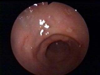 Hemoragická gastropatia - zadná stena tela žalúdka Obr.6. Erozívna akútna gastritída - rozhranie telo-antrum Obr.7.