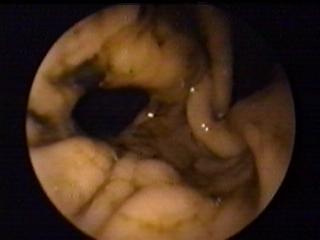 110 Obr.25. Obrovská paraezofageálna hernia - prográdny pohľad na časť žalúdka dislokovanú do mediastina Obr.26.