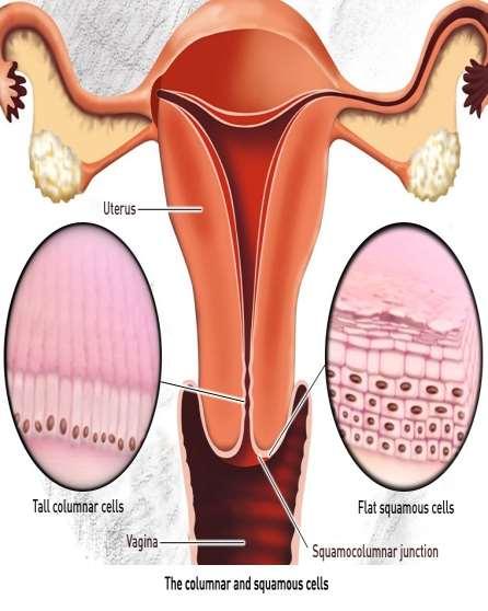 HPV HR a adenoléze Human papillomavirus prevalence and typedistribution in cervical glandular neoplasias: Results from a European multinational epidemiological study Katsiaryna Holl1*, Andrzej M.