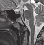1: Magnetická rezonance: vlevo transversální řez Thornwaldtova cysta; vpravo sagitální řez Thornwaldtova cysta; dole uprostřed sagitální řez obraz normální adenoidní vegetace S laskavým svolením