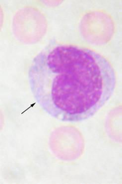 Monocyty 5 % v DBOK velikost: 15 20 m cytoplazma objemná, šedomodrá, nespecifická granula a četné