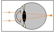 Těžkou myopii provázejí progresivní patologické změny v oku (zkapalnění sklivce, degradace sítnice). Myopické oko lze korigovat nejslabší možnou rozptylnou čočkou.