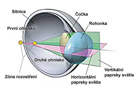 Obr. 4 Astigmatismus [29] Klasifikací astigmatismu je několik, nejzákladnější je dělení na astigmatismus pravidelný a nepravidelný.