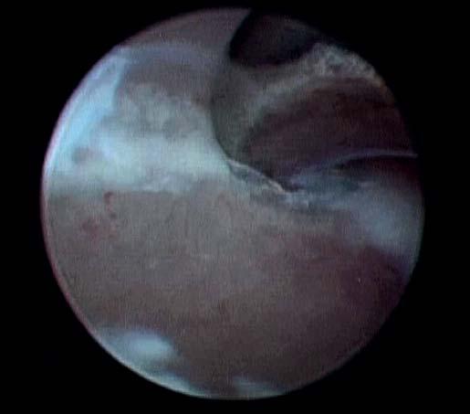 3 CBCT dorzálně, radioulnární inkongruita (pacient 1) Nápadná byla výrazná subchondrální sklerotizace ulny v oblasti celého MCP. Samotný apex coronoidu byl zaoblený.