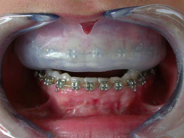 Oddaluje měkké tkáně rtů a tváří od zubů a chrání je před lacerací a zhmožděním nepravidelně postavenými zuby během úderu. 2. Chrání zuby před přímými frontálními údery a rozkládá sílu nárazu. 3.