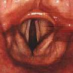 Hrtan chrupavky, vazivo, svaly fce: kašlel, řeč Snadno otékají hlasivky a epiglotis (infekce, popálení) neprůchodnost DC: hlasová štěrbina = nejužší místo dýchacích cest