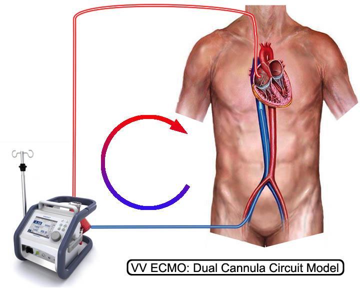 VV ECMO, průměrně 94%