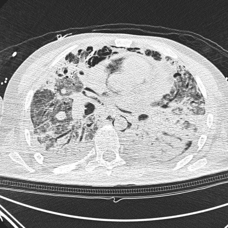 Těžké barotrauma jako indikace k ECMO Muž 30 let,