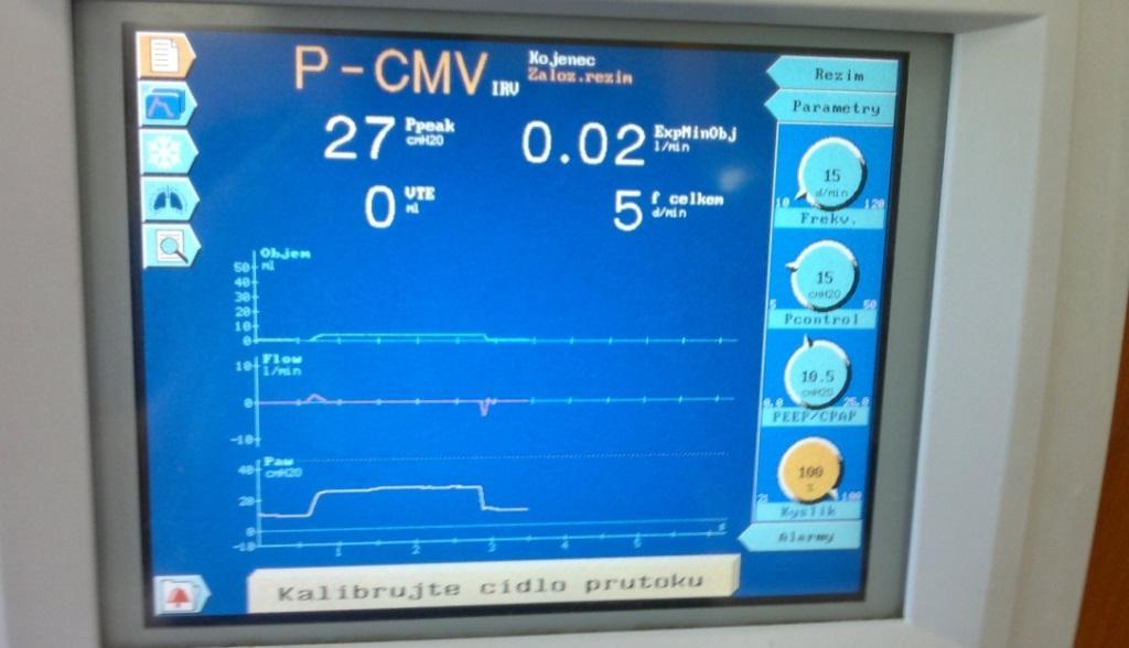 Transport na ECMO, celková doba na ECMO :30 dní