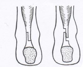 Prodlužuje se Achillova šlacha, šlachy flexorů prstů a palce nohy a uvolňuje se nebo se prodlužuje šlacha m. tibialis posterior. Současně se uvolňují všechna interskeletální ligamenta.