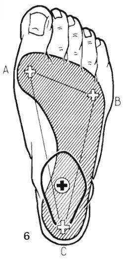 přirovnání nožní klenby k pružnému luku, kde jsou šlachy a svaly, udržující oblouky na noze, tětivou napínající luk (Buchtelová, Vaníková, 2011