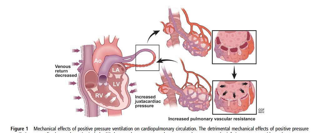 Effect of IPPV and PEEP on cardiopulmonary circulation 1. Snížený žilní návrat 2.