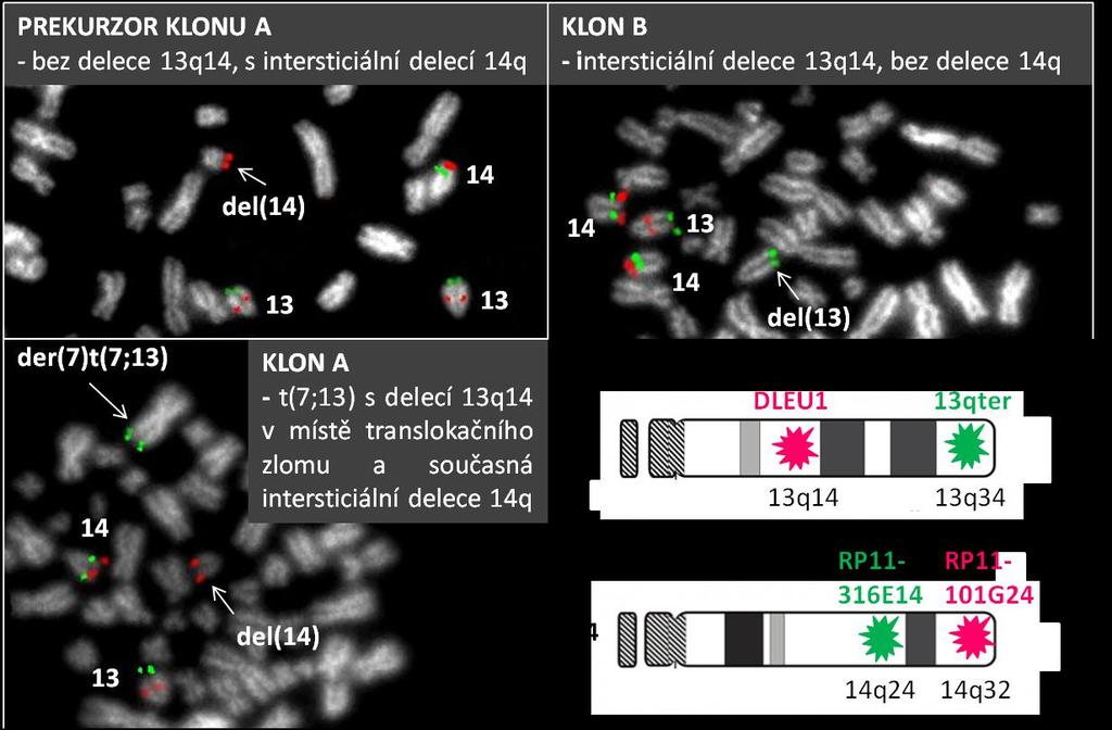 Průkaz nezávislého vzniku klonů s delecí 13q14 v místě translokačního zlomu a s intersticiální delecí 13q14 U jednoho z pacientů s koexistencí subklonů s oběma formami delece 13q14 (pac. č.